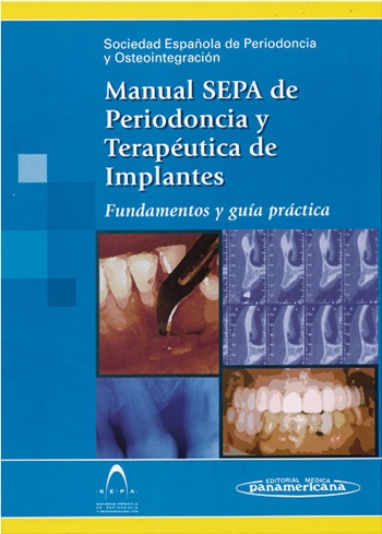 Manual Sepa De Periodoncia Y Terapeutica De Implantes: Fundamento S Y Guia Practica por Vv.aa.
